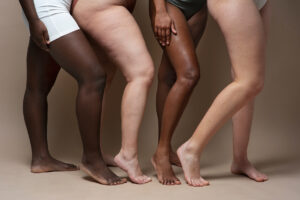 Lipedema-qué-es-y-tratamientos