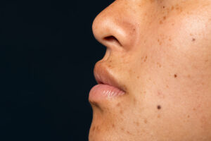 Melasma-manchas-en-la-piel