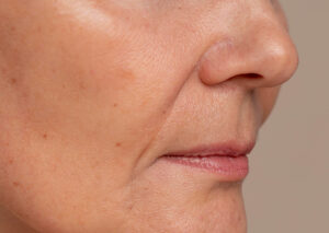 líneas-de-marioneta-cuidado-facial