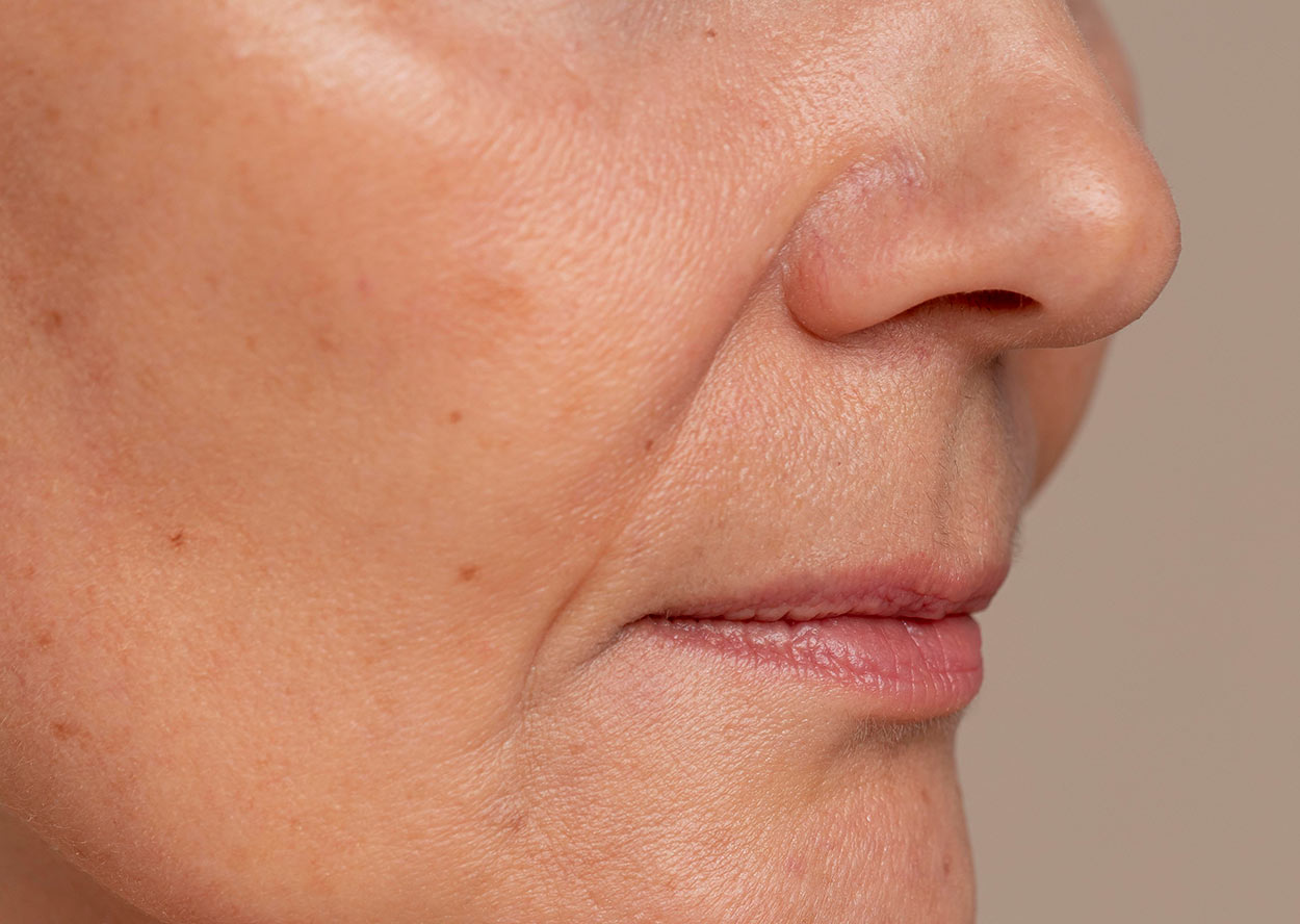 Qué son las líneas de marioneta y cómo prevenir su aparición